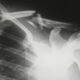 Shoulder Pain: Why Is It So Common?